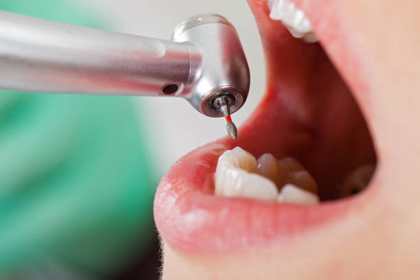 Best Emergency Wisdom Teeth Removal in Mastic, NY